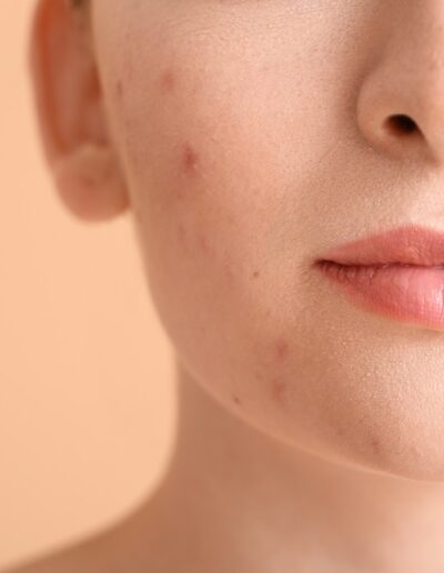 acne acne scars 1